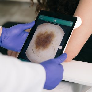 Esame Nevi in Epiluminescenza